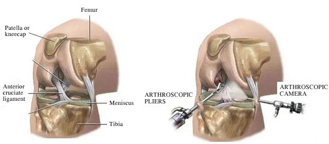 Операция артроскопия коленного. Артроскопия ПКС коленного сустава. Операция артроскопия коленного сустава. Разрыв мениска артроскопия. Операции на коленном суставе стоимость