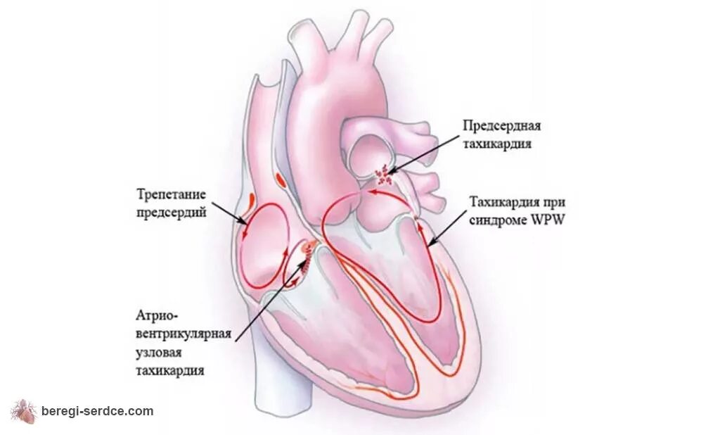 Можно ли вылечить тахикардию сердца. Тахикардия сердца. заболевание сердца тахикардия. сердечно сосудистая тахикардия. тахикардия симптомы.