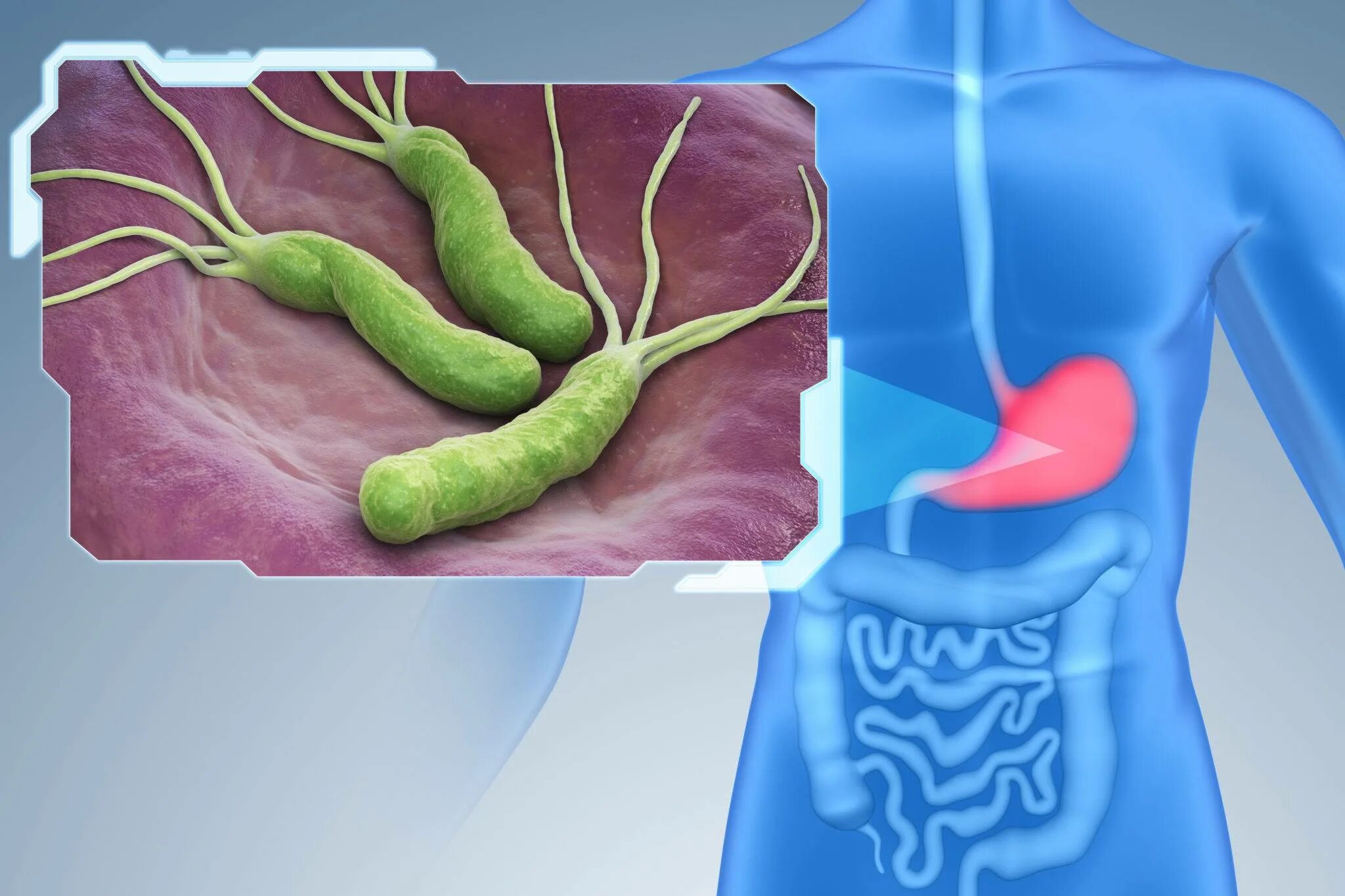Helicobacter pylori колонизируется в. Хелико бактерия пилори. Гастрит бактерия helicobacter. Какая бактерия вызывает язву. Какая бактерия вызывает язву.