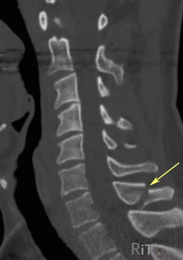 поврежденияпозвоночник. гемангиома тела тн5 позвонка. компрессионный перелом т12 позвонка позвоночника. перелом с7 позвонка рентген. краевой перелом тела l2 позвонка.