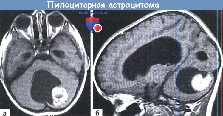 Пилоидная астроцитома. Пилоцитарная астроцитома мозжечка кт. Пилоидная астроцитома гистология. Пилоцитарная астроцитома головного.