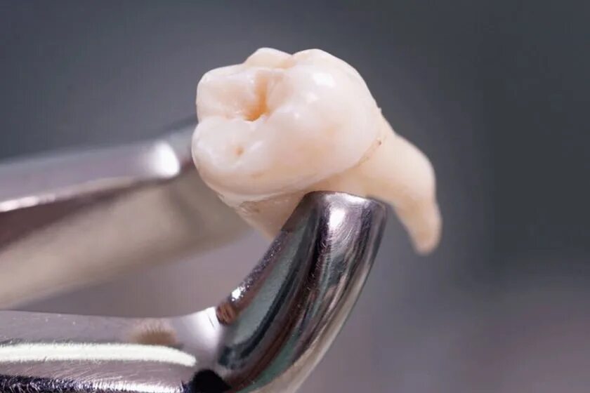 Удаление зуба. Зуб мудрости стоматология.