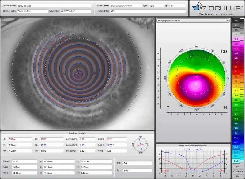 кератотопография глаза норма. кератотопография роговицы расшифровка. топографическое исследование роговицы. топография роговицы глаза. кератоконус топография роговицы.