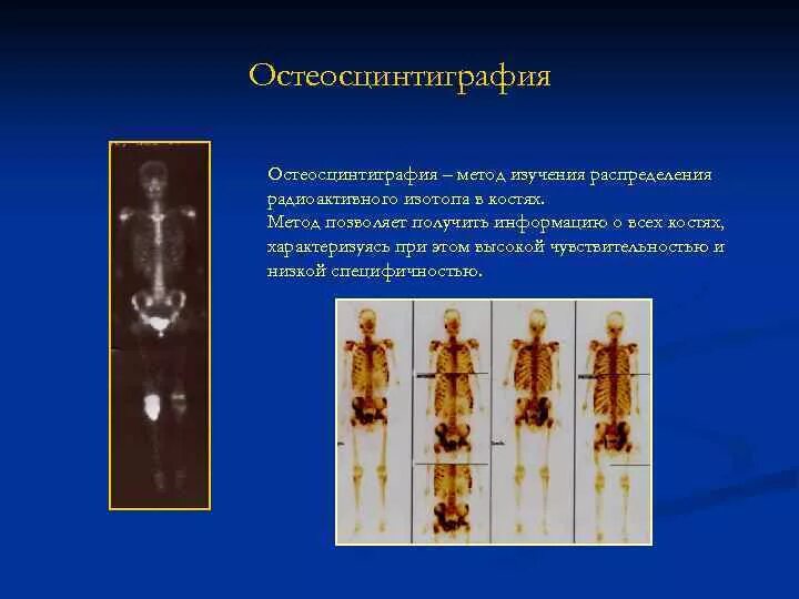 Исследование изотопами. Методика остеосцинтиграфии характеризуется. Остеосцинтиграфия диагностические методы. Остеосцинтиграфия костей.