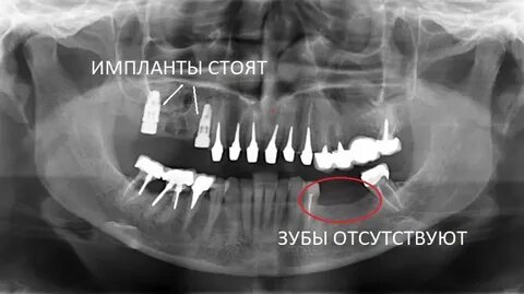 Импланты кт