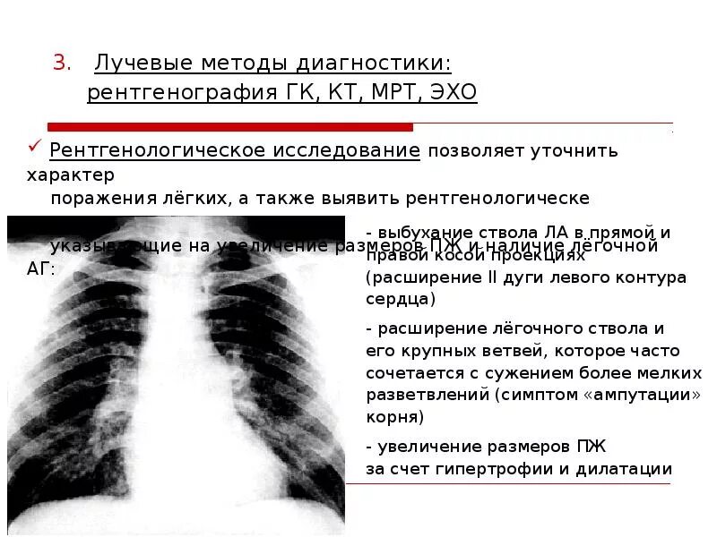 Легочный ствол на кт. Расширение легочного ствола на кт. расширение легочного ствола на рентгенограмме. расширение легочного ствола рентген. легочная гипертензия на кт.