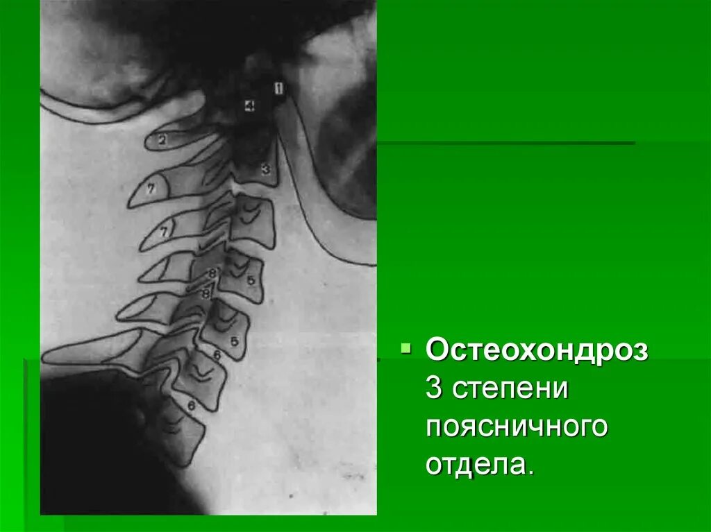 Остеохондроз поясничного отдела позвоночника периоды. Остеохондроз. Остеохондроз 1 стадии поясничного отдела. Остеохондроз 2 степени поясничного. Остеохондроз 2 стадии поясничного отдела.