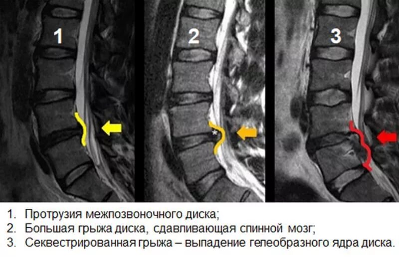 L5 s1 диск остеохондроз. Экструзия диска l5-s1 что это такое. Протрузии дисков l3-l5. Грыжа и протрузия поясничного отдела. Протрузия межпозвоночного диска мрт.