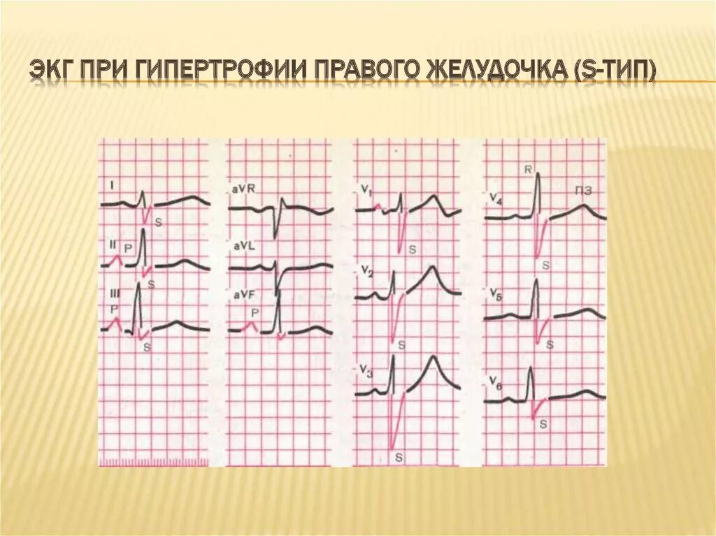 Глж на экг что это значит. Гипертрофия на ЭКГ. ЭКГ при гипертрофии левого правого желудочка. Гипертрофия желудочков на ЭКГ. ЭКГ при гипертрофии желудочков.