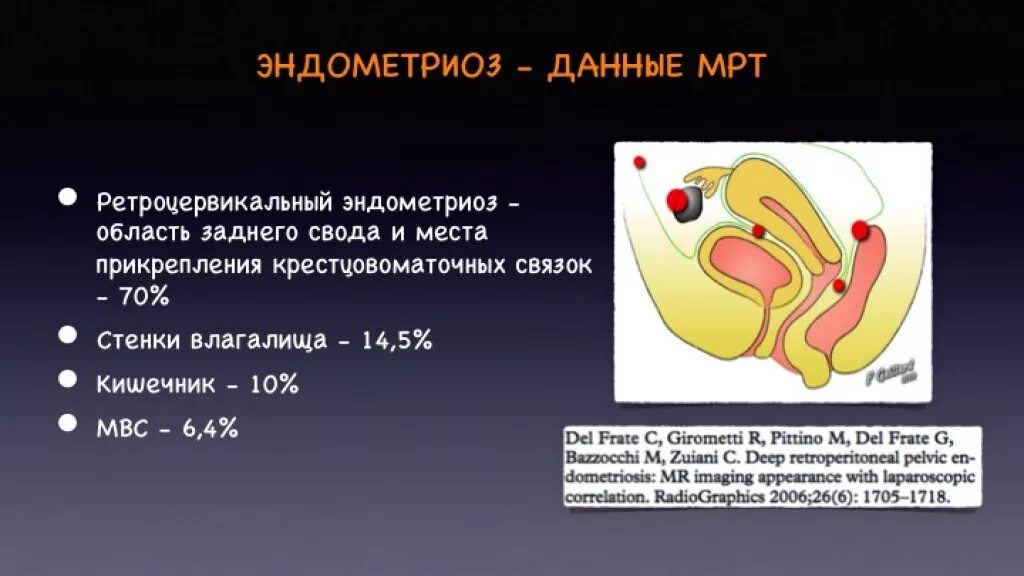 Что такое признаки внутреннего эндометриоза матки. Что такое признаки внутреннего эндометриоза матки