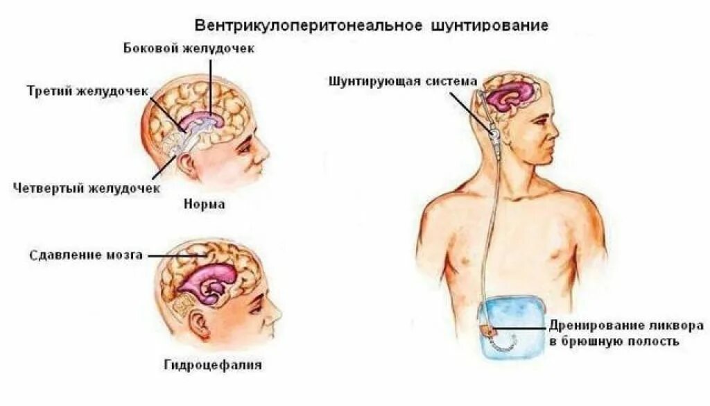 Головные шунты. Шунтирование гидроцефалии головного мозга. Вентрикулоперитонеальный шунт схема. Шунтирующие системы при гидроцефалии. Гидроцефалия головного шунт.