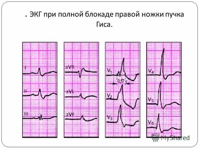 Блокада верхнего пучка гиса. ЭКГ при блокаде правой ножки пучка Гиса. Блокада левой ножки пучка Гиса на ЭКГ. ЭКГ при полной блокаде правой ножки пучка Гиса. Блокада ПНПГ.