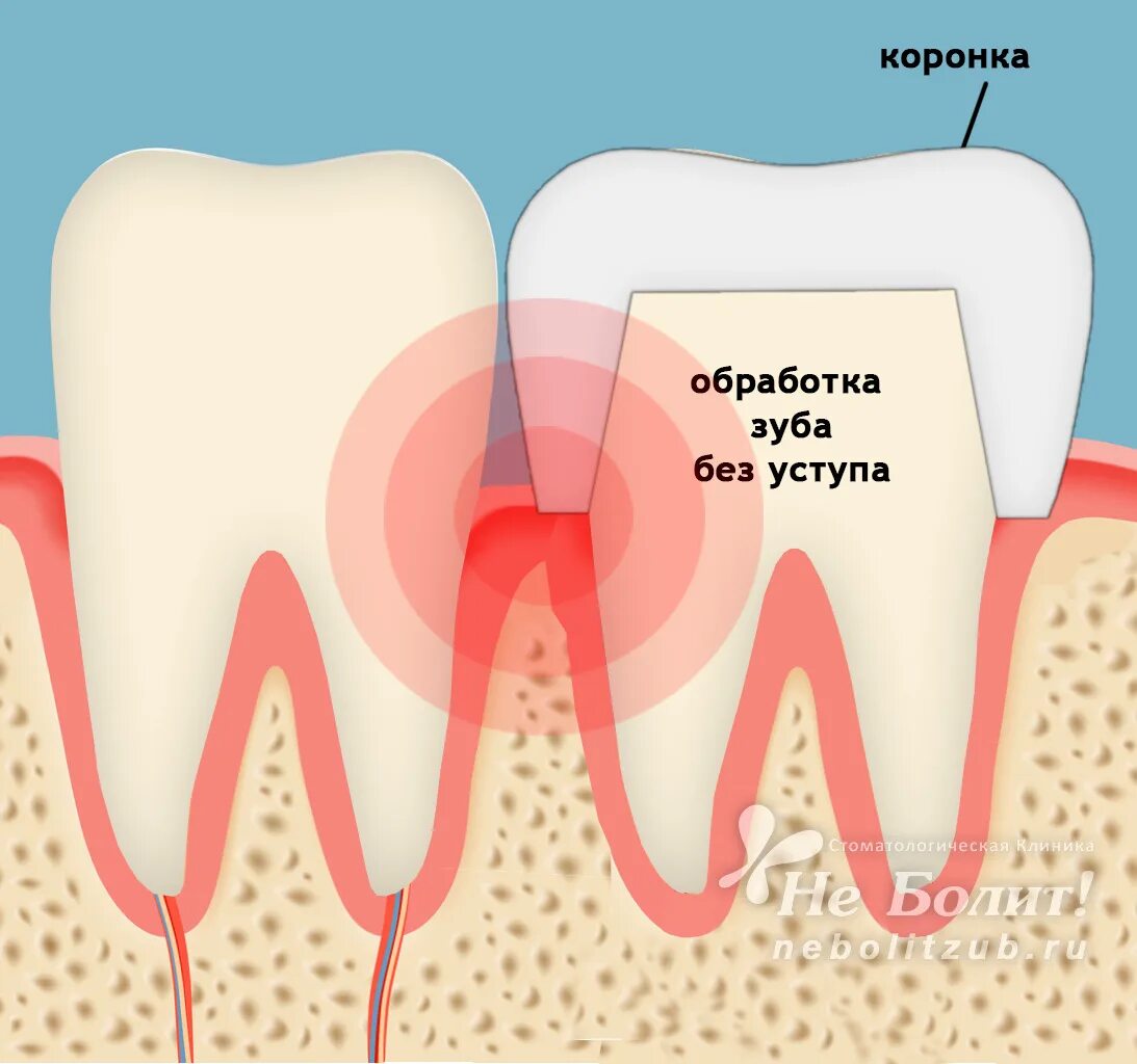 Болит зуб под коронкой.