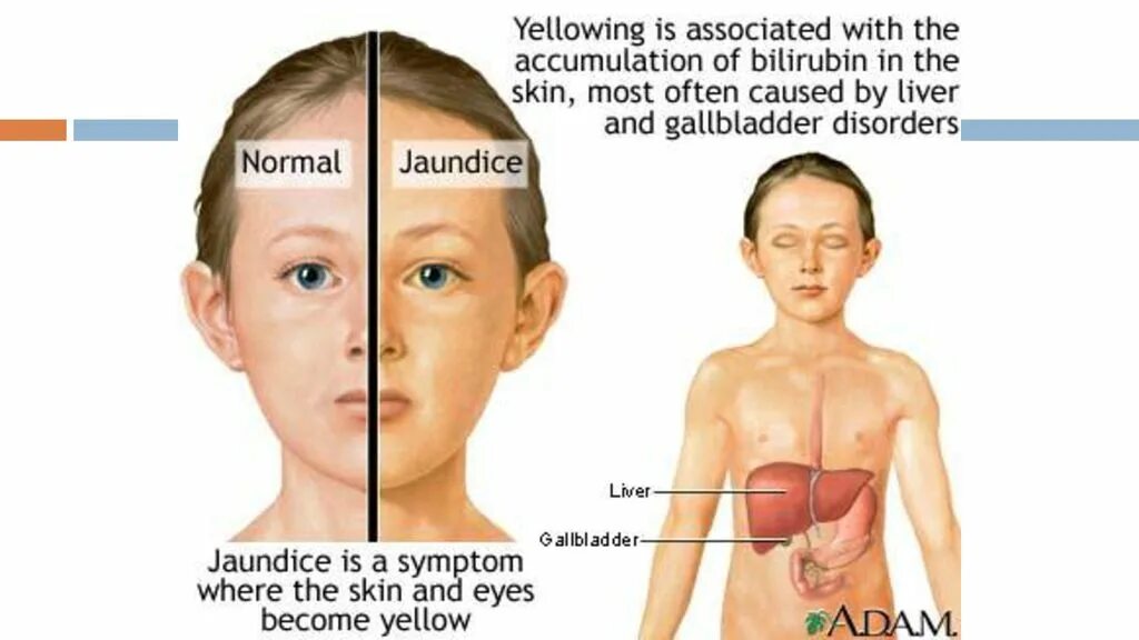 Гепатит а последствия. Желтушный синдром у детей.