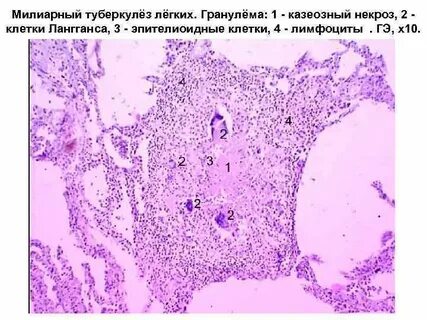 Милиарный туберкулез легких описание