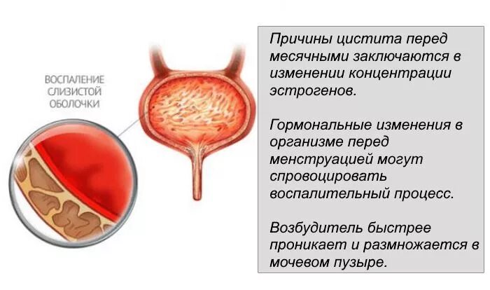 Боль при мочеиспускании при месячных. Воспалительный процесс в мочевом пузыре.