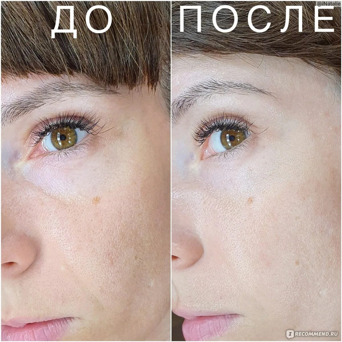 Микротоки лицо до и после фото отзывы. Foreo bear до после. foreo до и после. foreo bear отзывы до и после фото. щёточка форео для лица отзывы с фото до и после.