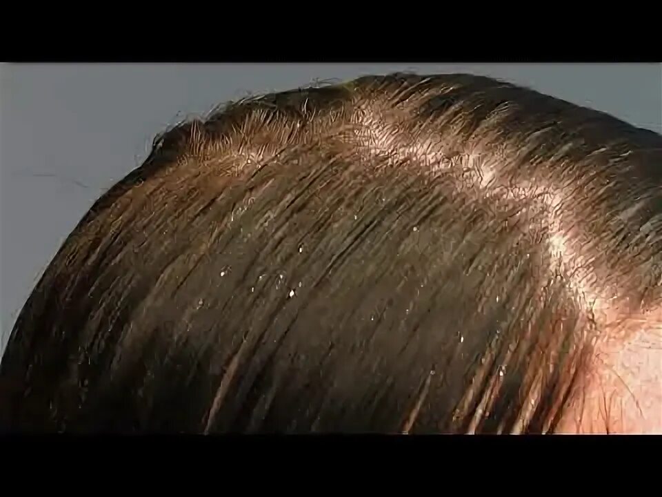 Head lice nidirect