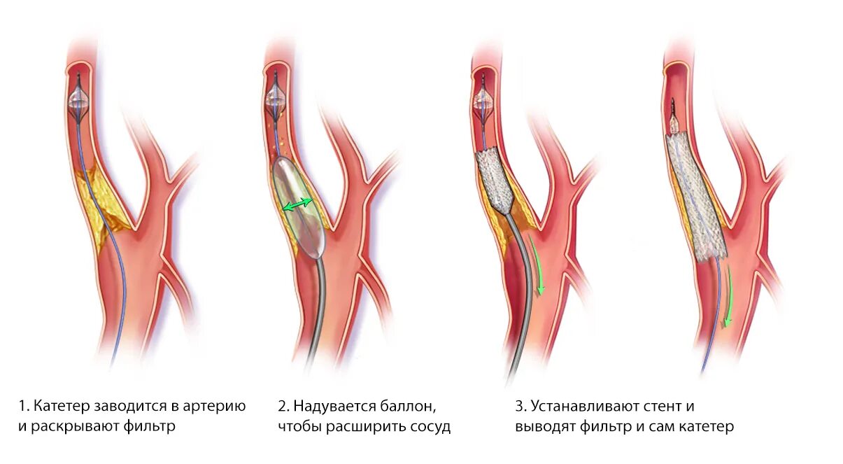 Операция через сосуды. Стентирование сосудов сонной артерии. Каротидная эндартерэктомия показания. Ангиопластика позвоночной артерии. Операция каротидная эндартерэктомия ход операции.