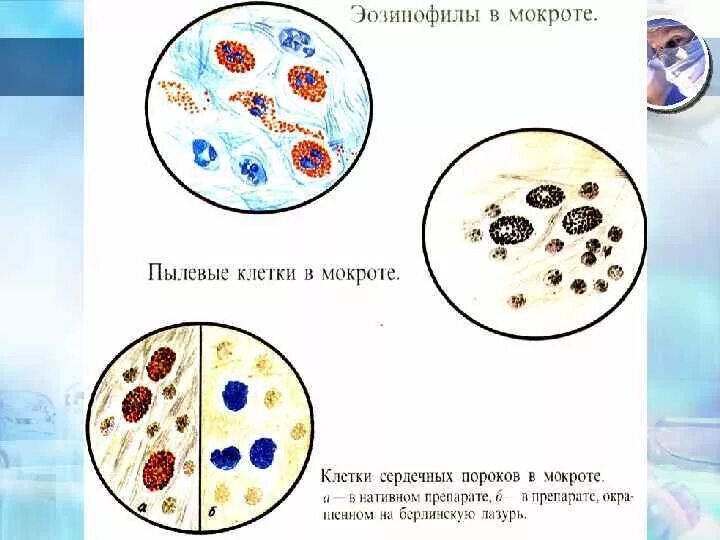 В мокроте можно обнаружить. Макрофаги в мокроте микроскопия. Эозинофилы в мокроте микроскопия. Пылевые клетки в мокроте.