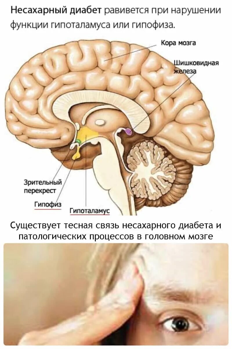 Нарушения работы гипофиза заболевания. Несахарный диабет. Центральный несахарный диабет. Гипофизарный несахарный диабет. Несахарный диабет гипоталамус.