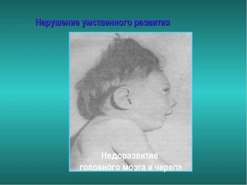 Недоразвитие зон мозга. Недоразвитие головного мозга. Нарушение умственного развития. Патология умственного развития.