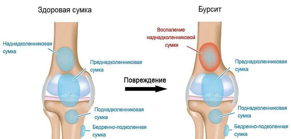 Бурсит колена коленного сустава. Около уставные сумки коленного сустава. Бурсит синовиальной сумки коленного сустава. Супрапателлярный бурсит коленного сустава на кт.