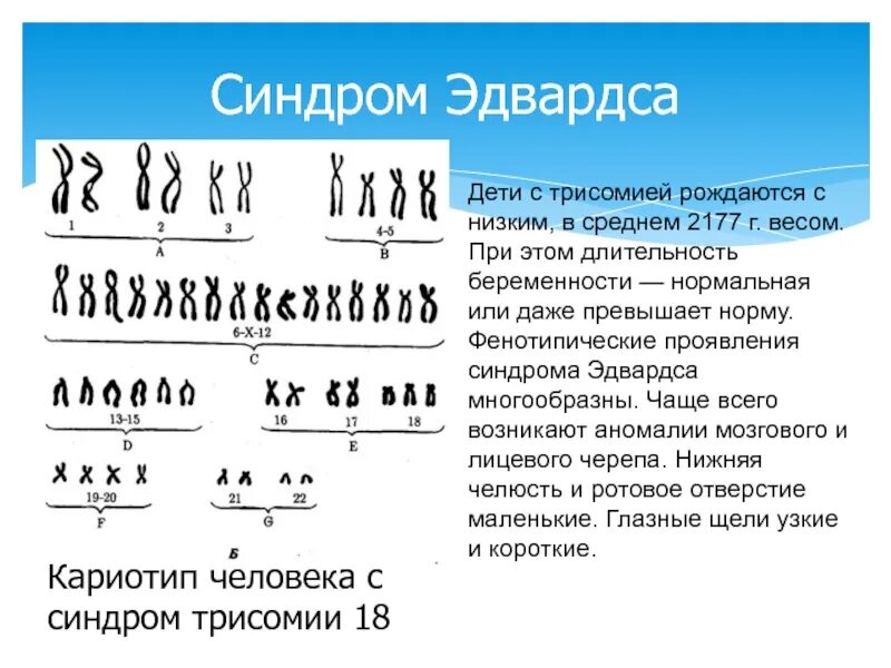 Появление дополнительной хромосомы. Кариотип синдрома синдром Эдвардса. Трисомия синдром Эдвардса кариотип. Кариотип больных с синдромом Эдвардса. Кариотип человека с синдромом Эдвардса.