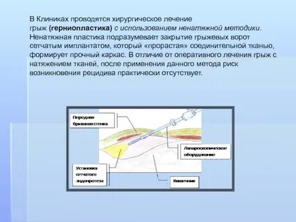 Хирургическое лечение грыж