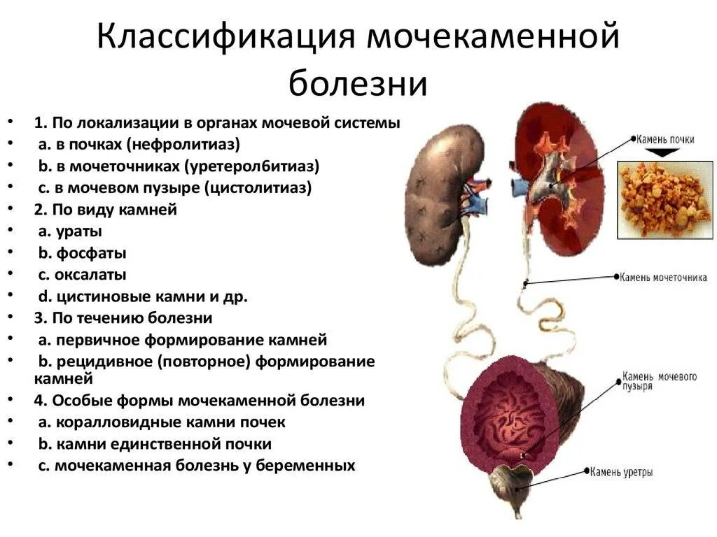 Мочевая инфильтрация. Почечнокаменная болезнь механизмы образования почечных камней. Мочекаменная болезнь классификация. Мочекаменная болезнь почек классификация. Мочевыделительная система при мочекаменной болезни.