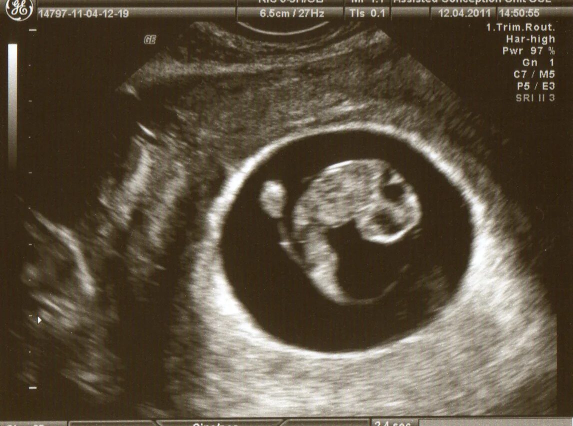УЗИ на 8 неделе беременности акушерской. Эмбрион на 8 неделе беременности УЗИ. Снимок УЗИ эмбриона на 8 неделе беременности. УЗИ на 7 акушерской неделе беременности. Как выглядит ребенок на 8 неделе