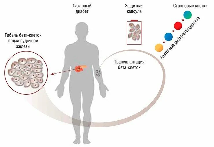 Стволовые клетки при сахарном диабете. Бета клетки при сахарном диабете 1 типа. Стволовые клетки и сахарный диабет 1 типа. Стволовые клетки метод лечения сахарного диабета. Пересадка поджелудочной железы при сахарном