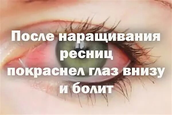 Капли после ресниц. Покраснение глаз от наращивания ресниц. Покраснение глаз после наращивания. Болит глаз после наращивания. Красные глаза и болят после наращивания.