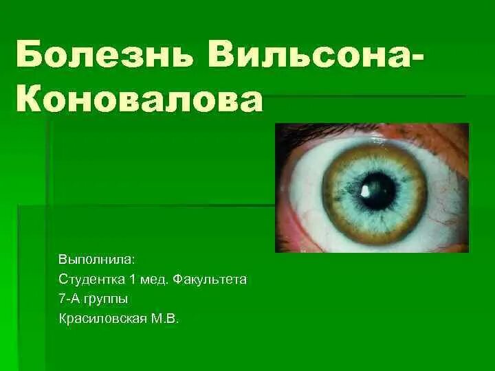 Синдром вильсона коновалова что это такое простыми. Кольца Кайзера Флейшера при Вильсона Коновалова. Биохимический маркер болезни Вильсона Коновалова. Болезнь Вильсона Коновалова клиника. Вильсона Коновалова болезнь мкб 10.