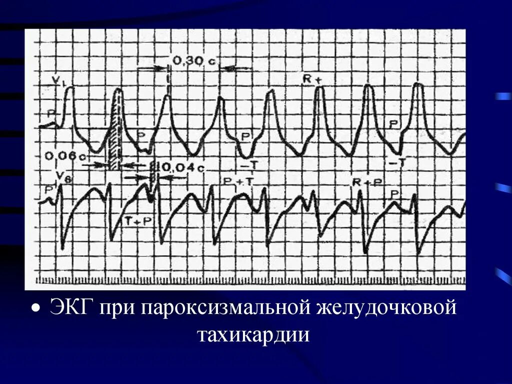 Желудочковая тахикардия на экг. Пароксизмальная желудочковая тахикардия на ЭКГ. Пароксизм желудочковой тахикардии ЭКГ. Пароксизмальная тахикардия желудочков ЭКГ. ЭКГ желудочковая тахикардия тахикардия.