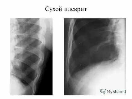 Плеврит у детей