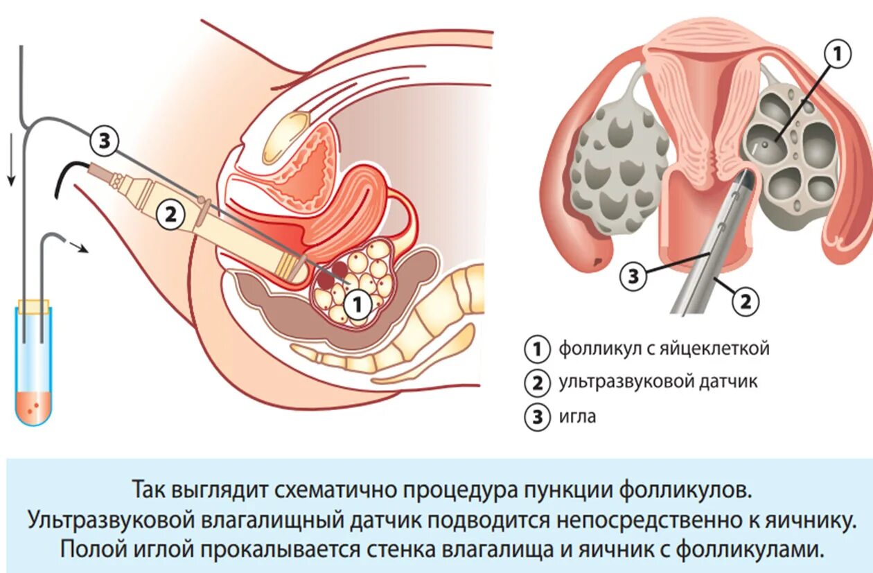 Пункция забора яйцеклетки. Трансвагинальная пункция яичников. Эко пункция яйцеклеток. Пункция яичников ооцитов.