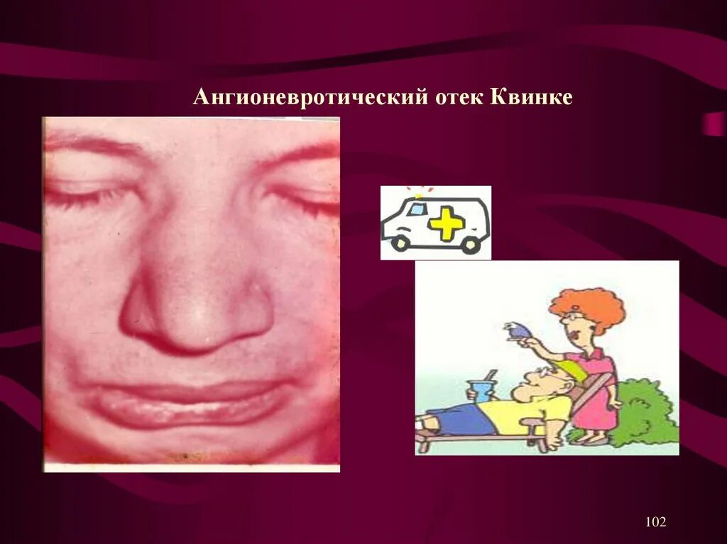 Первые симптомы отека квинке у взрослых