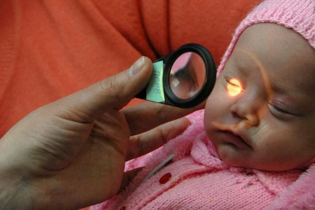 Чем обработать глаза новорожденному. Ретинопатия недоношенных. Лазерная коагуляция ретинопатия недоношенных. Ретинопатия недоношенных офтальмология.