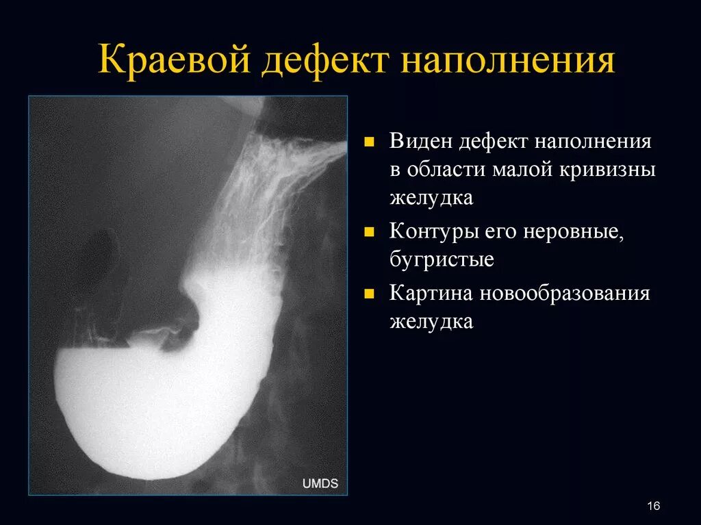 Краевой дефект наполнения желудка рентген. Дефект наполнения желудка рентген. Рентгенограмма дефекта наполнения желудка. Краевой дефект наполнения пищевода.