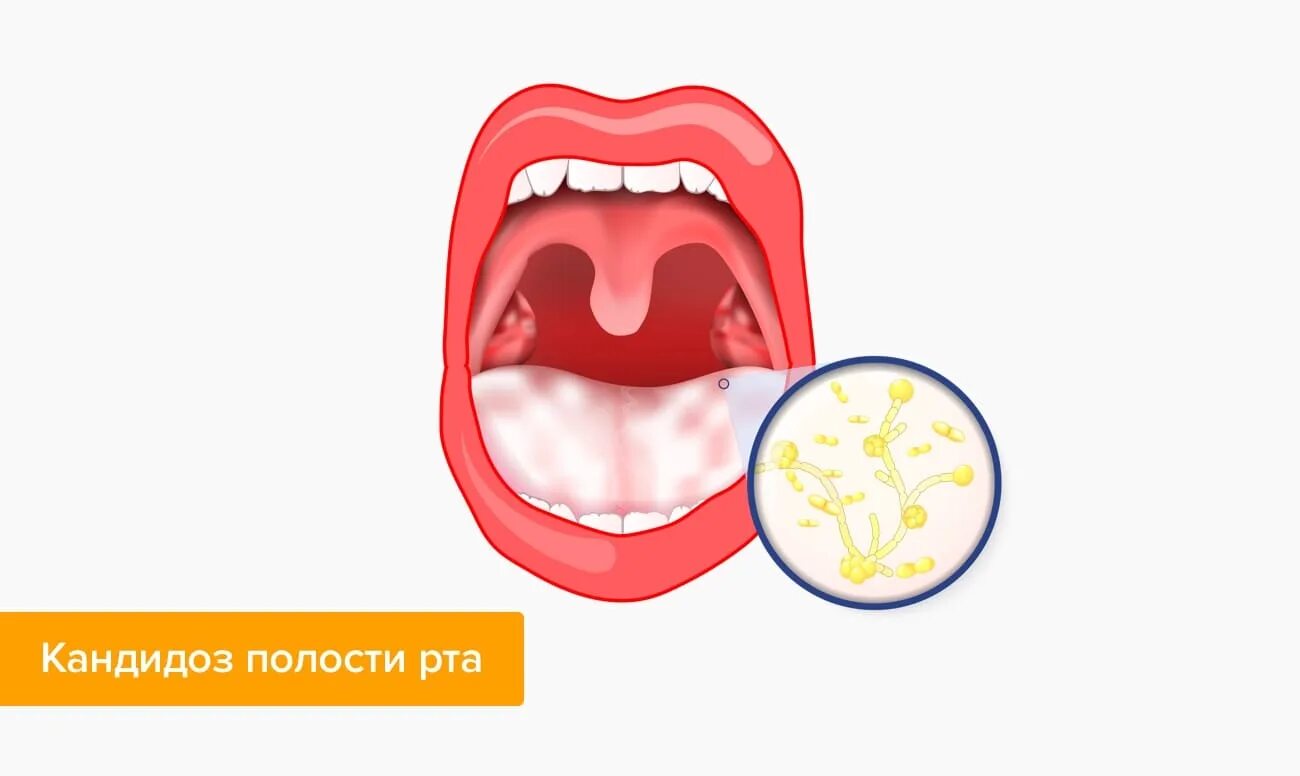 Молочница при сахарном диабете. Кандидоз слизистой оболочки полости рта. Кандидоз (молочница) слизистых оболочек. Грибок полости рта кандидоза. Грибковый (кандидозный) стоматит.