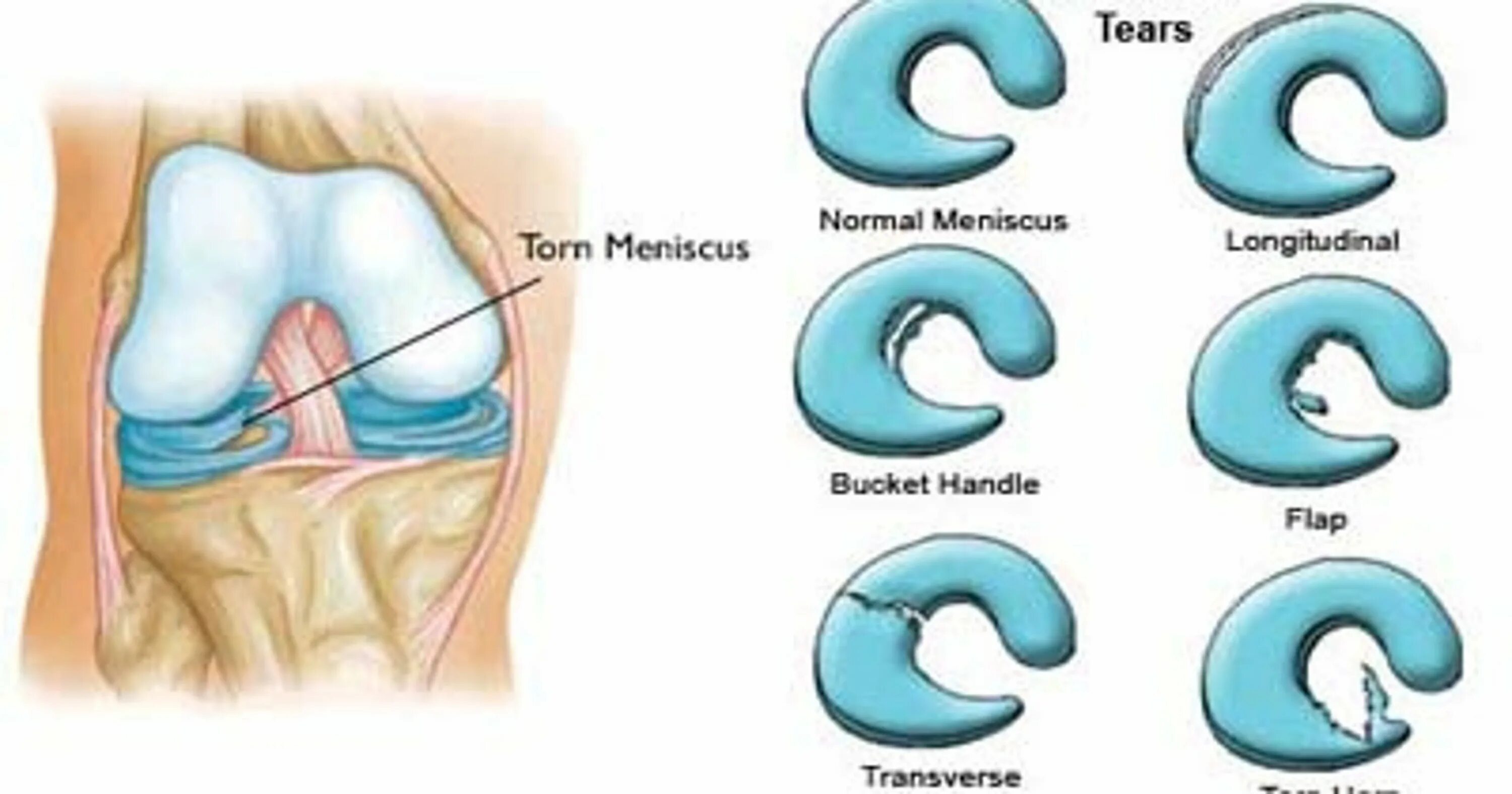 Разрыв ручка лейка. Задний Рог мениска коленного сустава. Повреждение латерального мениска по типу ручки лейки. Дегенеративный разрыв мениска. Лоскутный разрыв мениска.