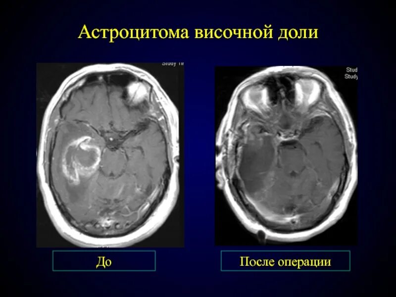 Анапластическая астроцитома лобной доли. Диффузная астроцитома мрт. Астроцитома теменной доли. Диффузная астроцитома