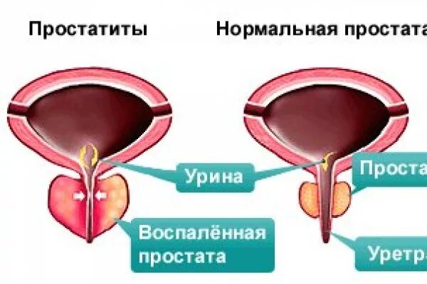 Бактерии простаты. Хронический простатит. Хронический бактериальный простатит.