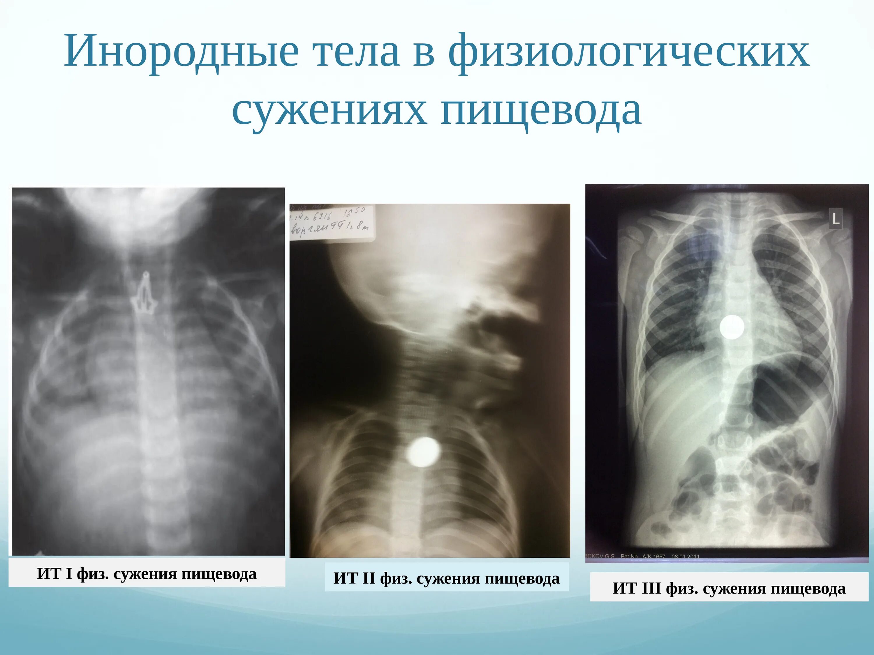 Тело пищевода. Инородные тела пищевода. Инородное тело пищевода рентген. Инородные тела у детей рентген. Физиологические сужения пищевода рентген.