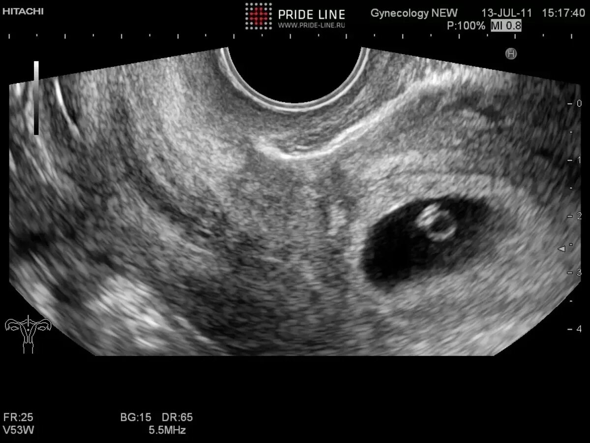 Беременность на ранних сроках. Замершая беременность на раннем сроке фото. Неразвивающаяся беременность. Задержка 6 недель