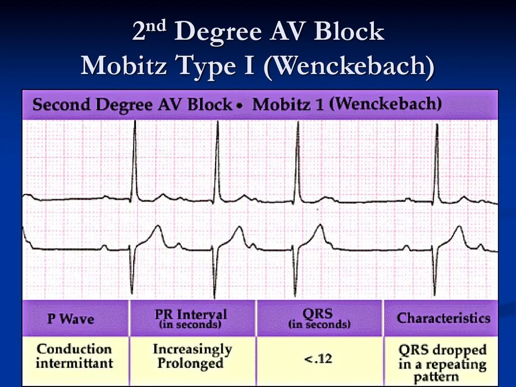 Av block remover сайт. Second degree (Wenckebach). ECG av Block 3. Av Block ECG обзор. Mobitz Type 1.