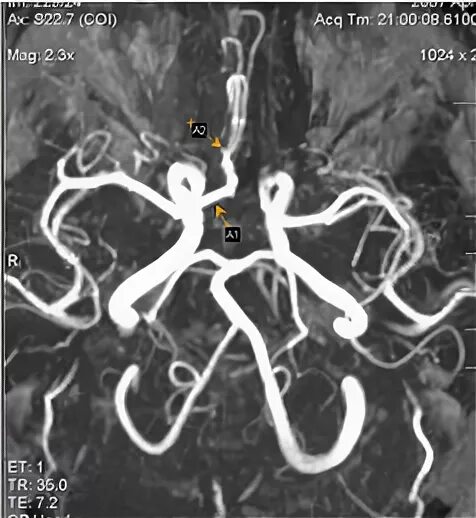 Сегмент а1 пма. Передняя трифуркация ПМА. Аплазия а1 сегмента правой передней мозговой артерии.