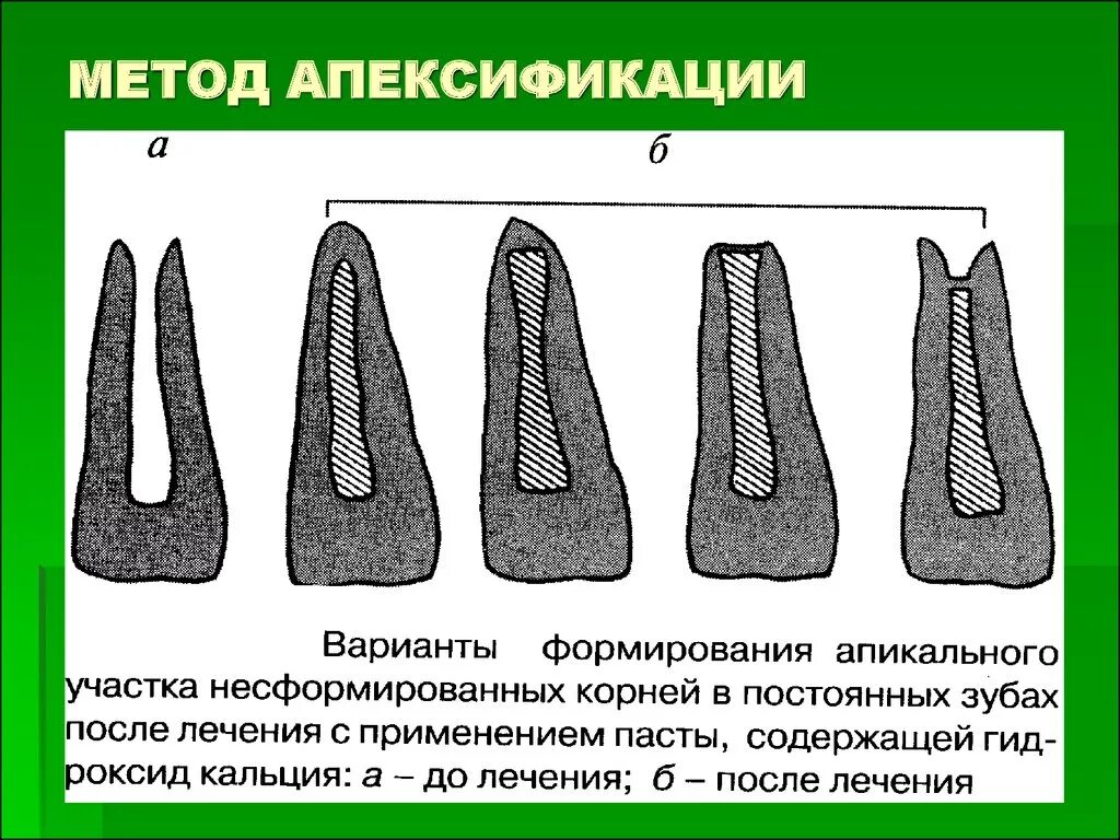 Схема апексификации верхушки зуба по Франку. Методика апексификации. Апексогенез и апексификация. Апексоыикация метрдика.