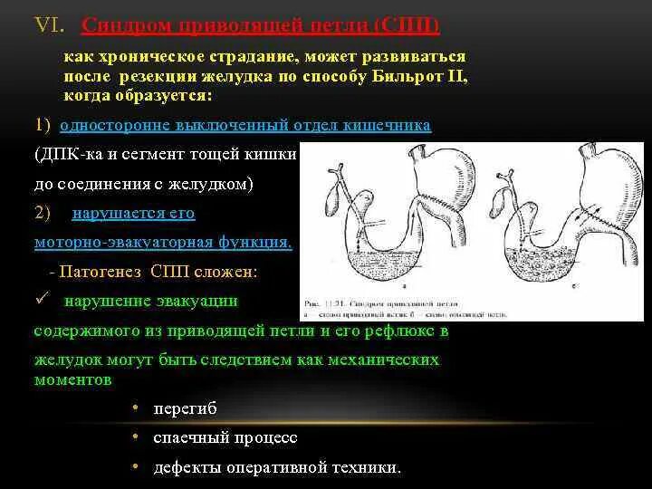 Клинические формы синдрома приводящей петли. Дистальная резекция желудка Бильрот 1. Резекция желудка Бильрот 1 этапы.